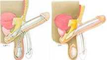 Prótese Peniana, maleável ou inflável. Dr Abrão Lincoln. dentistasrio.com.br/site/medicos-no-rio.php