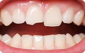 Atendimento de Traumas: Quedas (piscina, skate, bicicleta...)Dra. Gláucia Athayde-DentistasRio.com.br