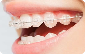 Aparelhos Ortodônticos Estéticos Dra. Glaucia Athayde - DentistasRio.com.br