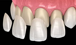 lentes de contato e facetas dentárias - Dr. João Carvalho