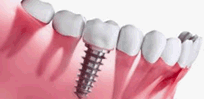 Implantes Dentários e Orofacias no consultório e home care