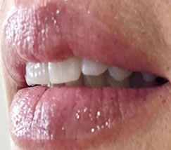 Revitalização labial, com efeito gloss, com Dra Luciana Maribondo - DentistasRio.com.br