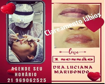 Clareamento dos lábios, em uma seção, com Dra Luciana Maribondo - DentistasRio