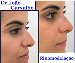 Rinomodelação - Dr. João Carvalho