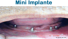 Mini Implantes com Dr. Xavier